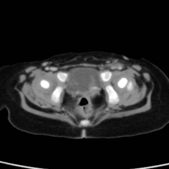 Neuroblastoma with skull metastases (Radiopaedia 30326-30960 C 58).jpg
