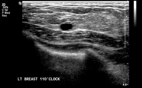 File:Neurofibromatosis of breast (Radiopaedia 5921-7462 B 1).jpg