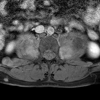 File:Neurofibromatosis type 1- extensive spinal involvement and Christmas tree sign (Radiopaedia 60610-68332 Axial T1 C+ fat sat 67).jpg