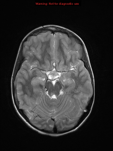 File:Neurofibromatosis type 1 with optic nerve glioma (Radiopaedia 16288-15965 Axial T2 16).jpg