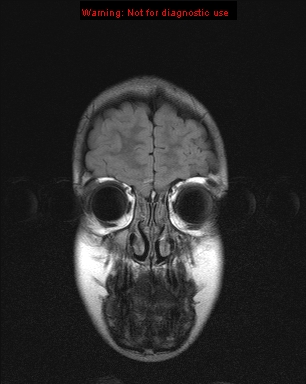 File:Neurofibromatosis type 1 with optic nerve glioma (Radiopaedia 16288-15965 Coronal FLAIR 23).jpg