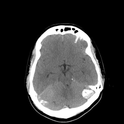 File:Neurofibromatosis type 2 (Radiopaedia 25389-25637 Axial non-contrast 9).jpg