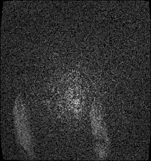 Neurofibromatosis type 2 (Radiopaedia 79097-92049 Axial T1 C+ 199).jpg