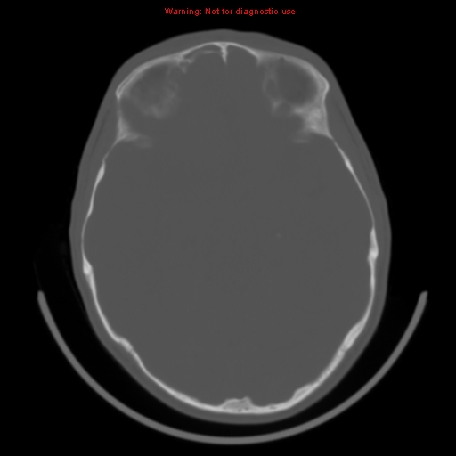 File:Neurofibromatosis type 2 (Radiopaedia 8953-9732 Axial bone window 15).jpg