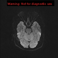 File:Neuroglial cyst (Radiopaedia 10713-11184 Axial DWI 38).jpg