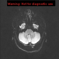 File:Neuroglial cyst (Radiopaedia 10713-11184 Axial DWI 40).jpg