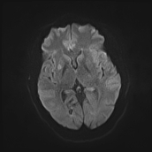 File:Neurotoxoplasmosis - concentric target sign (Radiopaedia 70644-80784 Axial DWI 11).jpg