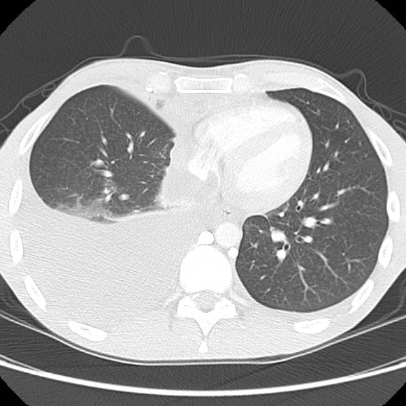 File:Non-Hodgkin lymphoma involving lung (Radiopaedia 29094-29470 Axial lung window 46).jpg