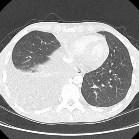 File:Non-Hodgkin lymphoma involving lung (Radiopaedia 29094-29470 Axial lung window 50).jpg