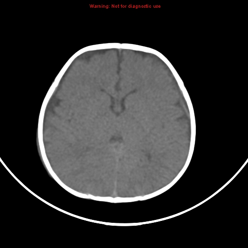 File:Non-accidental injury - bilateral subdural with acute blood (Radiopaedia 10236-10765 Axial non-contrast 12).jpg