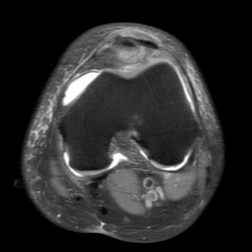 File:Non-displaced patella fracture (Radiopaedia 15932-15582 Axial PD fat sat 11).jpg