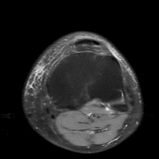 File:Non-displaced patella fracture (Radiopaedia 15932-15582 Axial PD fat sat 20).jpg