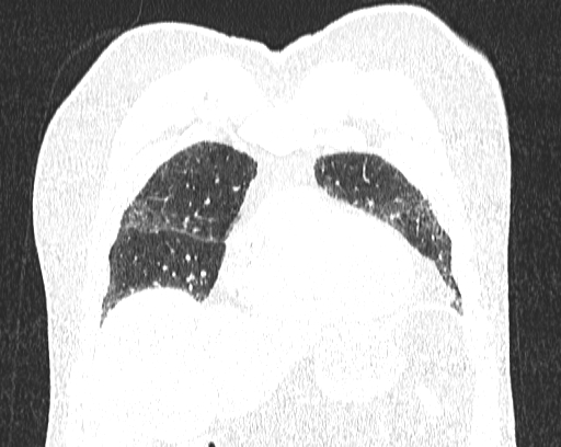 Non-specific interstitial pneumonia (NSIP) (Radiopaedia 68599-78228 Coronal lung window 18).jpg