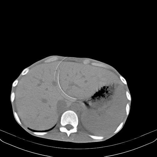 File:Non hodgkin lymphoma of the mediastinum (Radiopaedia 20814-20729 Axial non-contrast 34).jpg