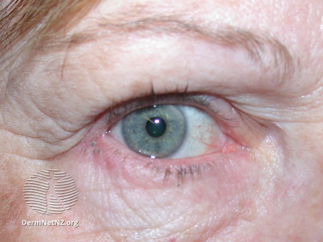 File:Nonspecific blepharitis (DermNet NZ site-age-specific-blepharitis2).jpg