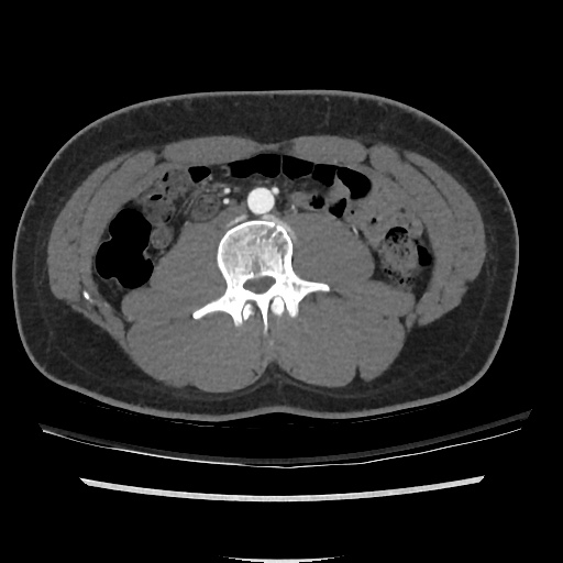 File:Normal CT angiogram of pelvis (Radiopaedia 45390-49430 A 7).jpg