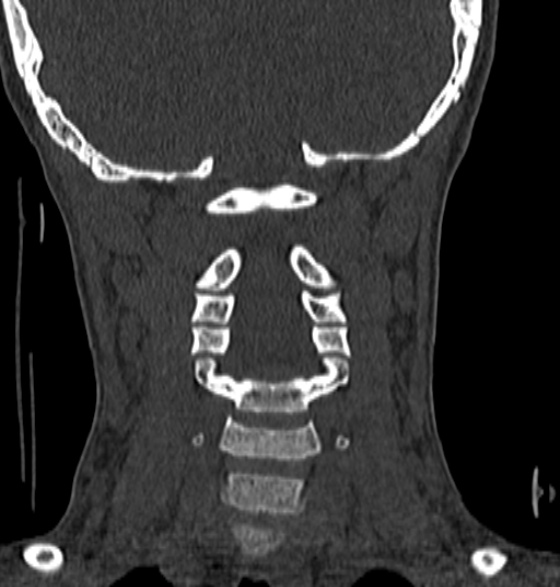 File:Normal CT cervical spine - 12-year-old (Radiopaedia 55352-61775 Coronal bone window 121).jpg