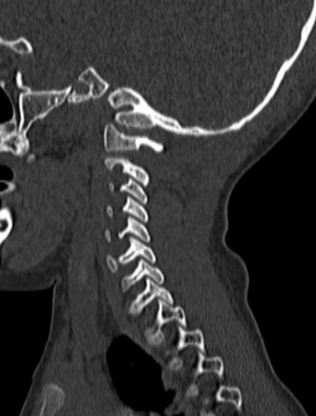 File:Normal CT cervical spine - pediatric (Radiopaedia 52549-58462 Sagittal bone window 43).jpg