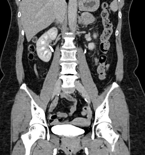 Normal CT intravenous urogram (Radiopaedia 39444-41759 A 280).jpg