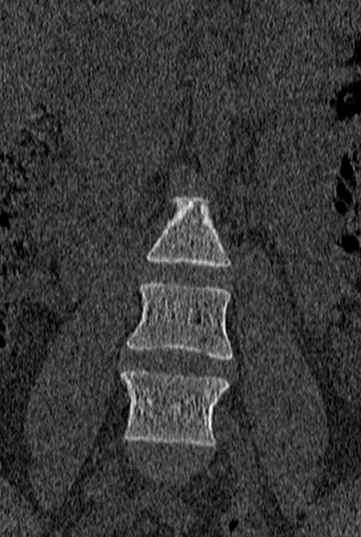 Normal CT lumbar spine (Radiopaedia 53981-60118 Coronal bone window 10).jpg