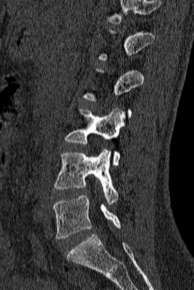 File:Normal CT lumbar spine (Radiopaedia 53981-60118 Sagittal bone window 35).jpg