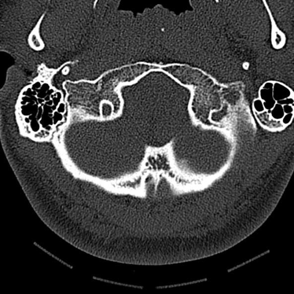 File:Normal CT of the cervical spine (Radiopaedia 53322-59305 Axial bone window 37).jpg