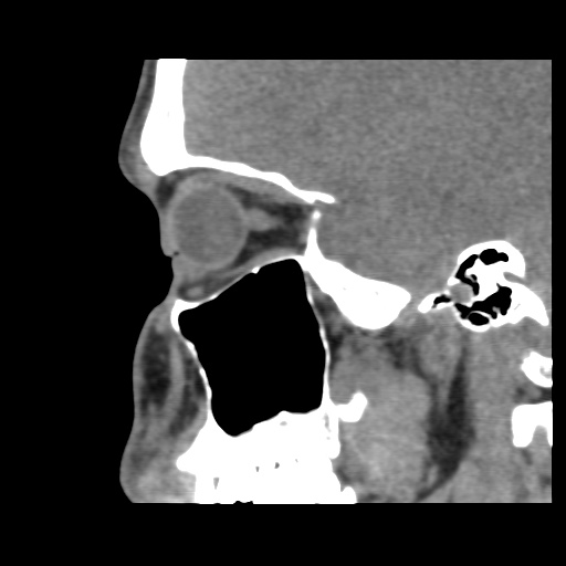 Normal CT paranasal sinuses (Radiopaedia 42286-45390 F 52).jpg