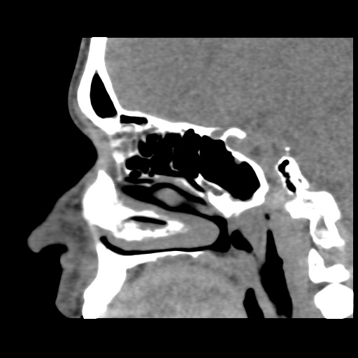 Normal CT paranasal sinuses (Radiopaedia 42286-45390 F 89).jpg