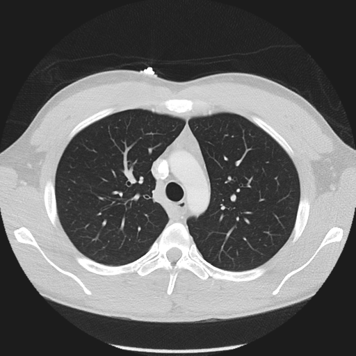 Normal CT pulmonary veins (pre RF ablation) (Radiopaedia 41748-44702 Axial lung window 1).png