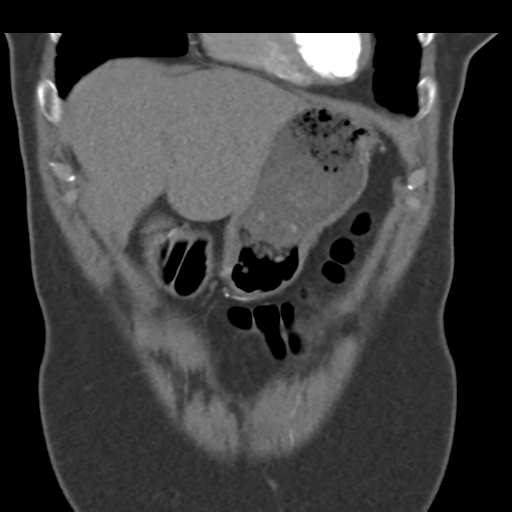 File:Normal CT renal artery angiogram (Radiopaedia 38727-40889 B 16).png
