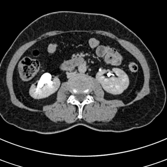 File:Normal CT split bolus study of the renal tract (Radiopaedia 48631-53634 Axial split bolus 113).jpg