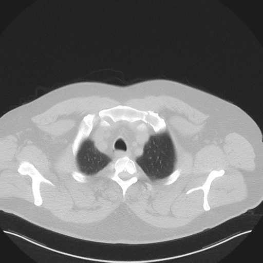 Normal HRCT (Radiopaedia 40797-43458 Axial lung window 8).png