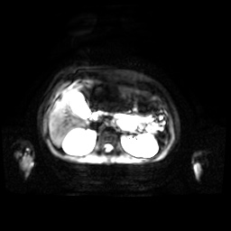 Normal MRI abdomen in pregnancy (Radiopaedia 88001-104541 Axial DWI 38).jpg