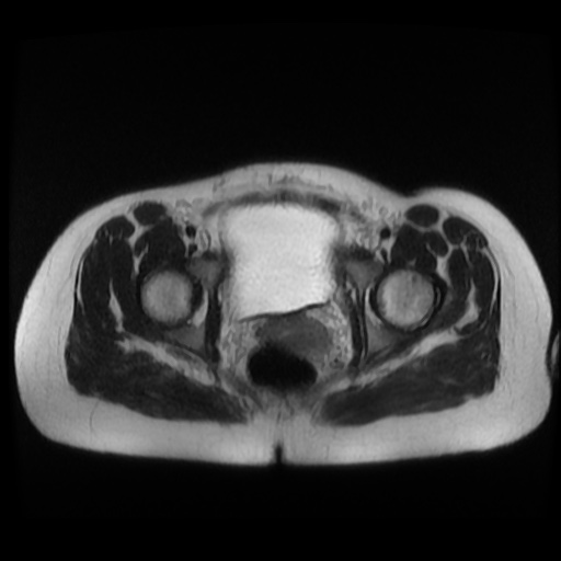 Normal MRI abdomen in pregnancy (Radiopaedia 88003-104546 Axial T2 46).jpg