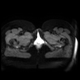 Normal MRI abdomen in pregnancy (Radiopaedia 88005-104548 Axial DWI 2).jpg