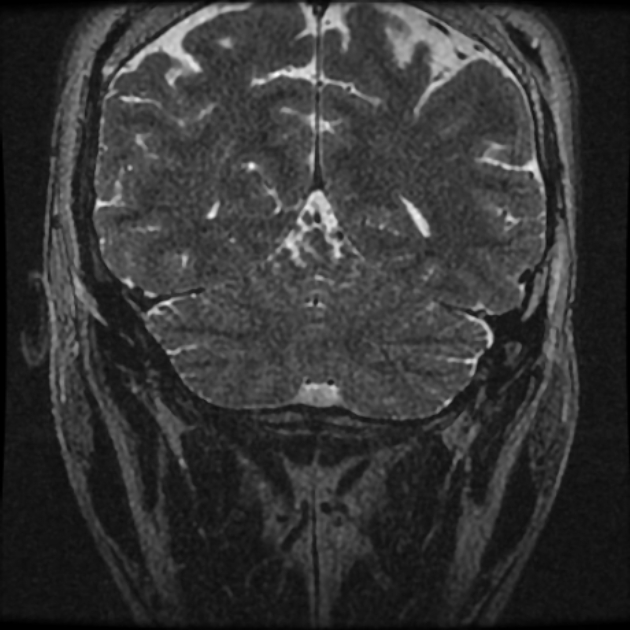 Normal MRI petrous (Radiopaedia 91317-108949 Coronal T2 120).jpg