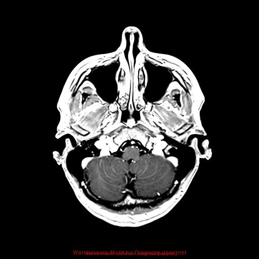 Normal adult brain MRI (non-enhanced and contrast-enhanced) (Radiopaedia 75262-86379 Axial T1 C+ 54).jpg