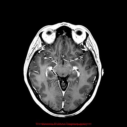 Normal adult brain MRI (non-enhanced and contrast-enhanced) (Radiopaedia 75262-86379 Axial T1 C+ 95).jpg