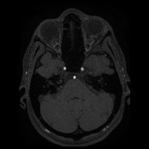 Normal brain MRA (Radiopaedia 41046-43793 Axial MRA 86).png