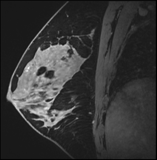 Normal breast MRI - dense breasts (Radiopaedia 80454-93850 I 104).jpg