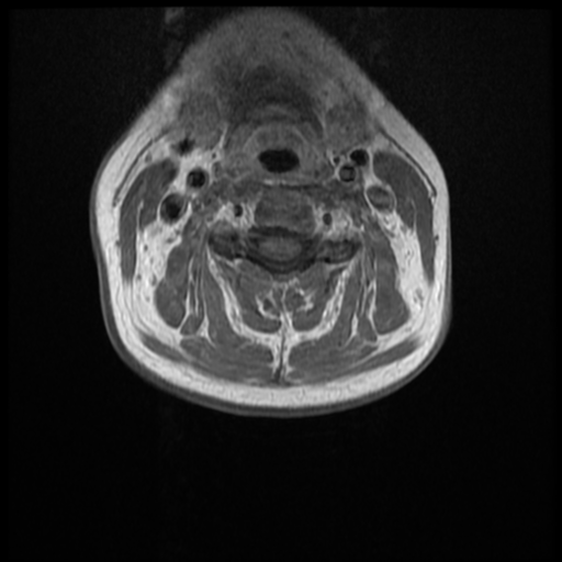 File:Normal cervical and thoracic spine MRI (Radiopaedia 35630-37156 Axial T1 C+ 20).png