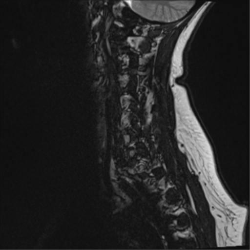 File:Normal cervical spine MRI (including Dixon) (Radiopaedia 42762-45925 Dixon- opposed phase 2).png