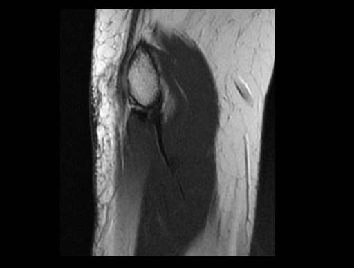 File:Normal elbow arthrograms (Radiopaedia 75550-86805 Sagittal PD 32).jpg