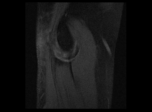 File:Normal elbow arthrograms (Radiopaedia 75550-86805 Sagittal T1 fat sat 14).jpg