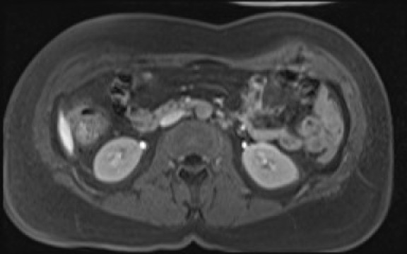 File:Normal hepatobiliary phase liver MRI (Radiopaedia 58968-66230 A 71).jpg