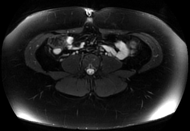 File:Normal liver MRI with Gadolinium (Radiopaedia 58913-66163 Axial T2 fat sat 2).jpg