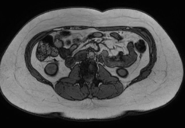 File:Normal liver MRI with Gadolinium (Radiopaedia 58913-66163 B 7).jpg