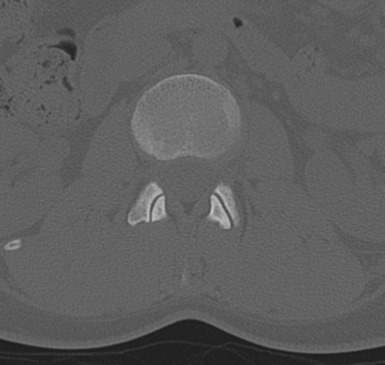File:Normal lumbar spine CT (Radiopaedia 46533-50986 Axial bone window 19).png
