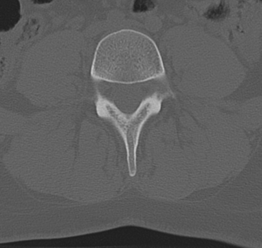 File:Normal lumbar spine CT (Radiopaedia 46533-50986 Axial bone window 49).png