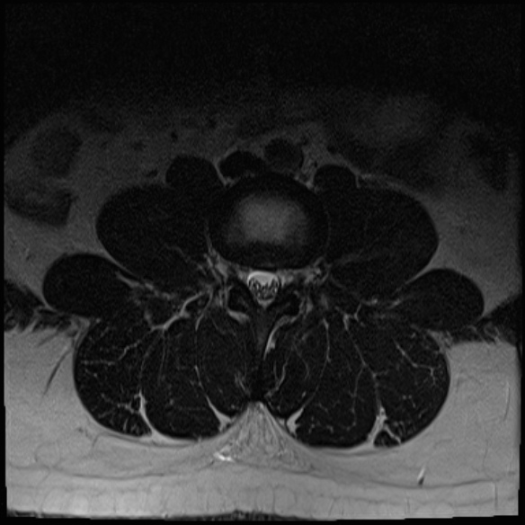 File:Normal lumbar spine MRI (Radiopaedia 47857-52609 Axial T2 6).jpg